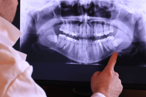 Best Emergency Root Canal Treatment in Bay City, MI